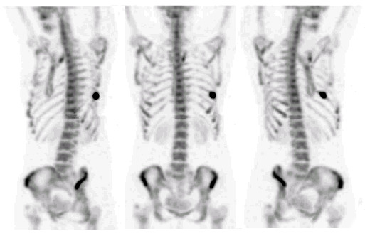 Ganzkörper SPECT 3-dimensional