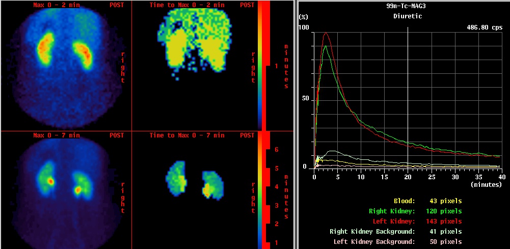 Nierenszintigraphie, nuklearmedizinische Nierendiagnostik