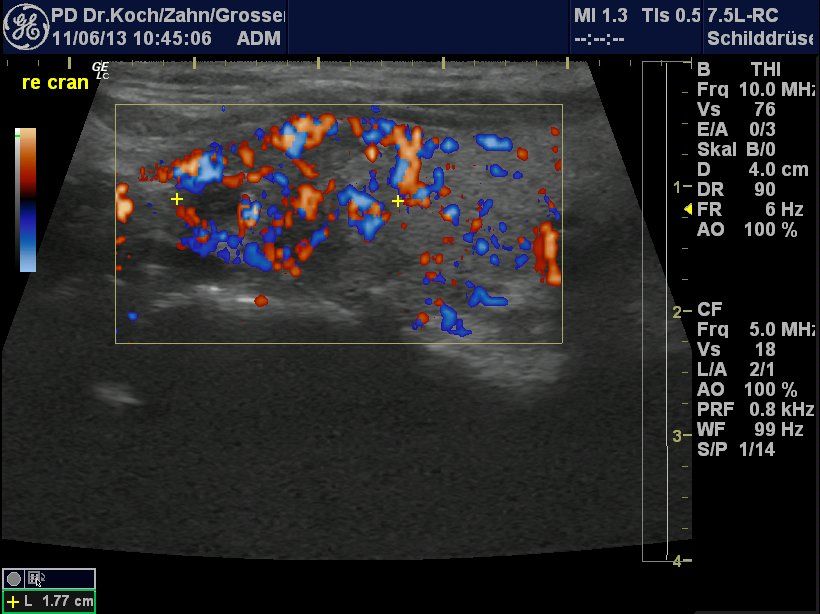 Sonographie Schilddrüsenkarzinom