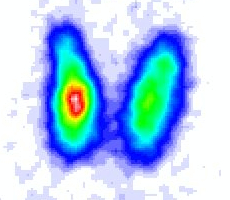 Schilddrüsenszintigramm